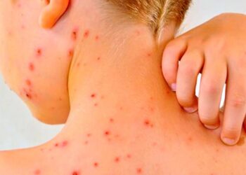 Semana Santa podría agravar brote de sarampión en México