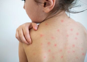 Sarampión aparece en 17 estados de México