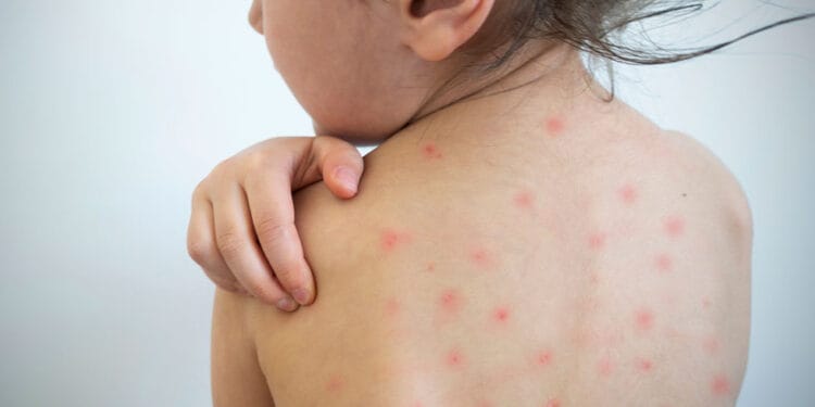 Sarampión aparece en 17 estados de México