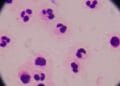 Jalisco confirma dos casos importados de ciclosporiasis